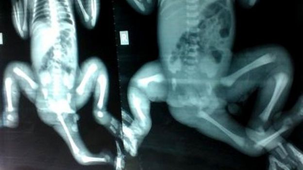 جراحة ناجحة لطفلة بنغالية مولودة بثلاثة أرجل 