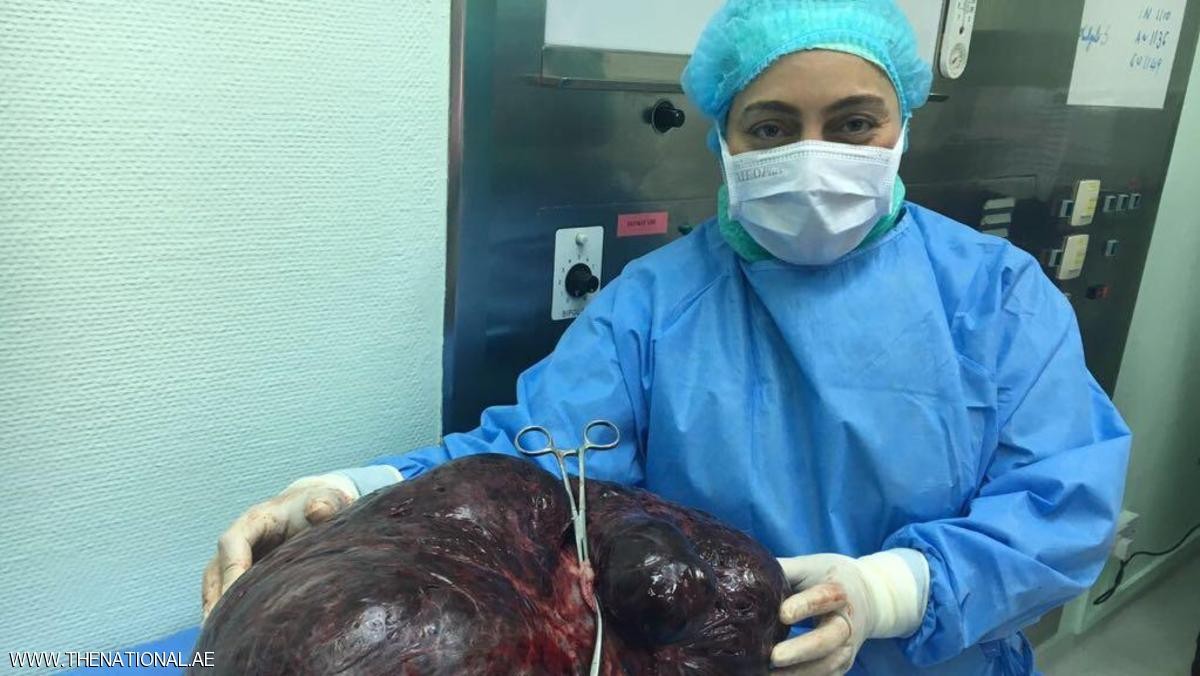 إزالة ورم يزن 17.5 كيلوغراماً من بطن امرأة في دبي 